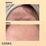 Before and after forehead acne improvement